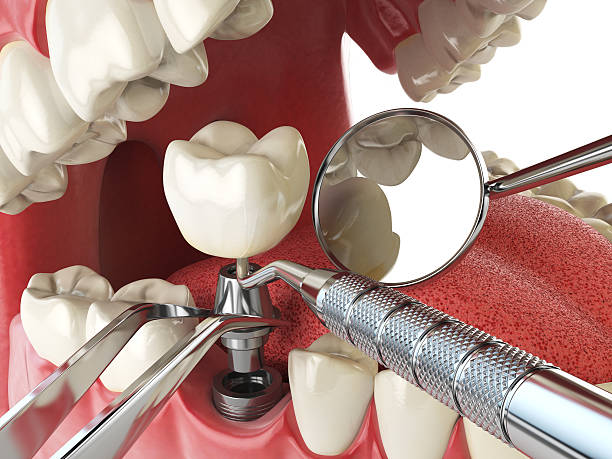 Best Emergency Denture Repair in New Beaver, PA